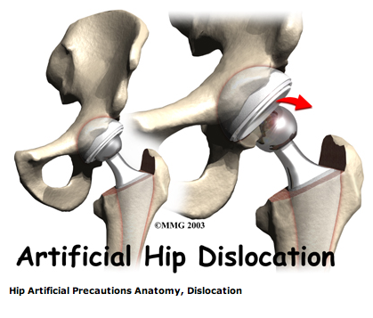 artificial_hip_dislocation.png