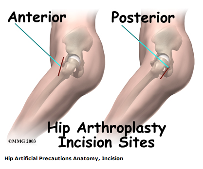 anterior-posterior_incision.png